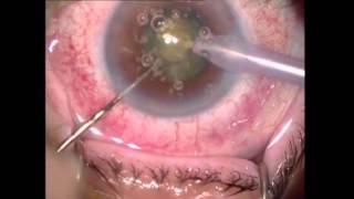 Chirurgie de la cataracte assistée par laser femtoseconde 2