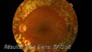 Rétinopathie diabétique proliférante