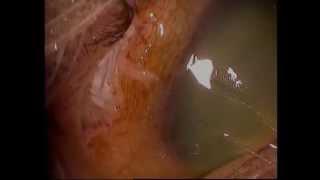 Trabéculectomie à la mitomycine dans le glaucome congénital