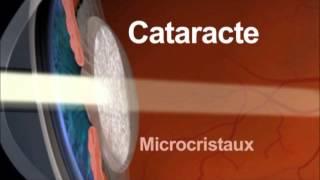 La Cataracte : Qu'est-ce que c'est ?