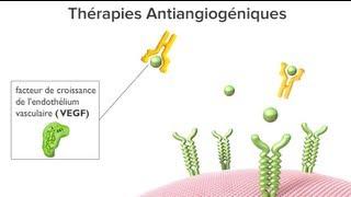Les thérapies antiangiogéniques pour la DMLA humide : Animation