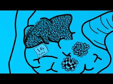 Qu'est-ce Que La Maladie D'Alzheimer ? - Www.maladie-alzheimer.fr