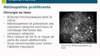 Les rudiments de la rétinopathie diabétique