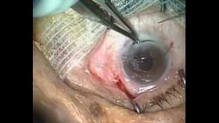 Chirurgie d'une cataracte totale brune par extraction extra capsulaire manuelle