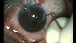 Chirurgie combinée cataracte et glaucome par Dr Yasser RIFAY