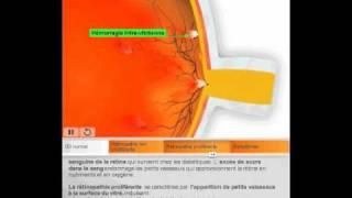 La Rétinopathie diabétique par Quantel Medical