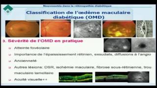 Rétinopathie diabétique: caractéristiques cliniques et thérapeutique