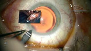 Opération de cataracte avec implant monofocal Dr Pierre-André DUVAL
