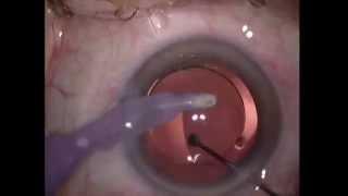 Chirurgie de  la cataracte / Cataract surgery