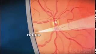 Rétinopathie diabétique
