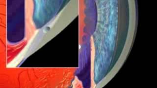 Glaucome