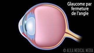 Glaucome à Angle Ouvert et Par Fermeture de l’Angle,  Animation Narré.