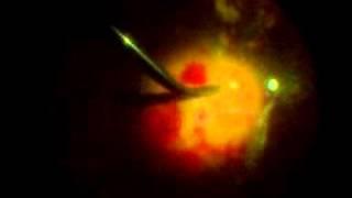 Chirurgie complexe de la rétine par Docteur Zidi Mohamed