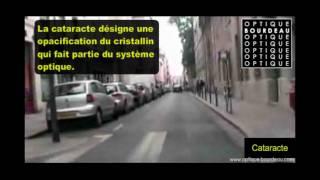 PATHOLOGIES DE BASSE VISION: dmla, cataracte, rétinopathie diabétique, glaucome