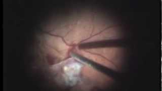 VITRECTOMIE DIABETE + AVASTIN