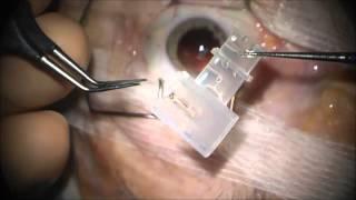 Chirurgie de la cataracte avec implantation mutifocale par le docteur Dominique PIETRINI