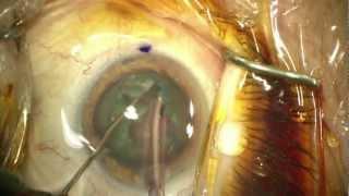 Chirurgie de la Cataracte   Dr COULLET Montpellier opération
