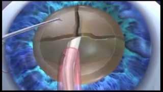 Chirurgie réfractive de la cataracte à l`aide du laser LenSx-Refractive cataract surgery with LenSx