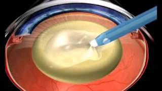Causes et symptomes d'une cataracte