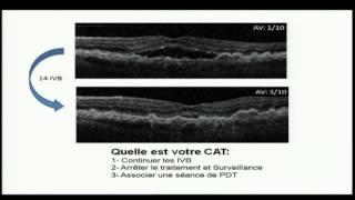 DMLA: Quand arrêter les injections ?