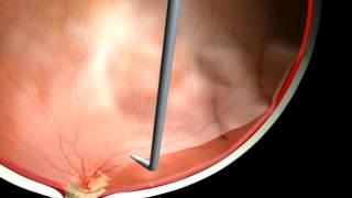 Technique de dissection de rétinopathie diabétique proliférente