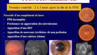 traitement au laser de la retinopathie Diabetique