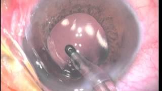 Vidéo N°3 centre du glaucome/Ezzouhairi/Chirurgie cataractes difficiles